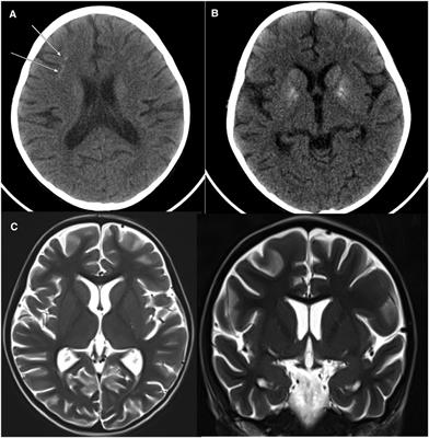 Case report: Durable response to ruxolitinib in a child with TREX1-related disorder